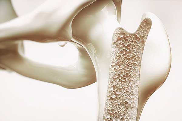 causas y tratamiento de la osteoporosis