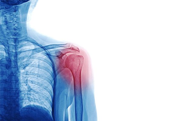 como-tratar-tendinitis-de-hombro