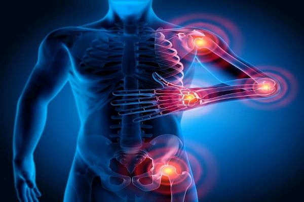 fibromialgia