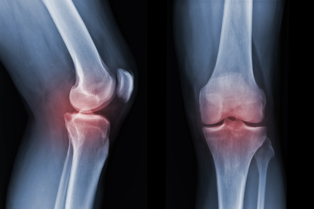 osteoporosis síntomas