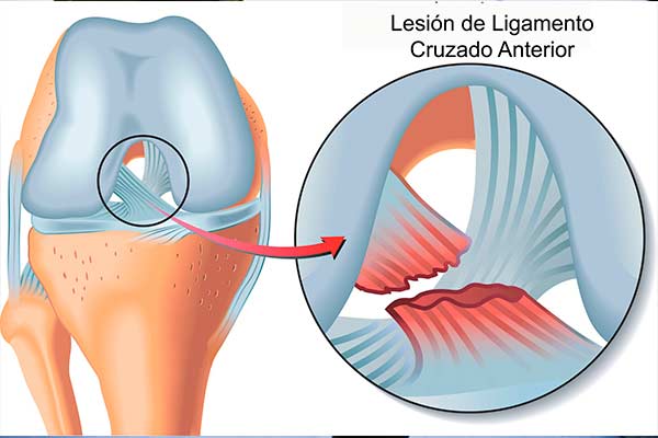 rotura-ligamento-cruzado